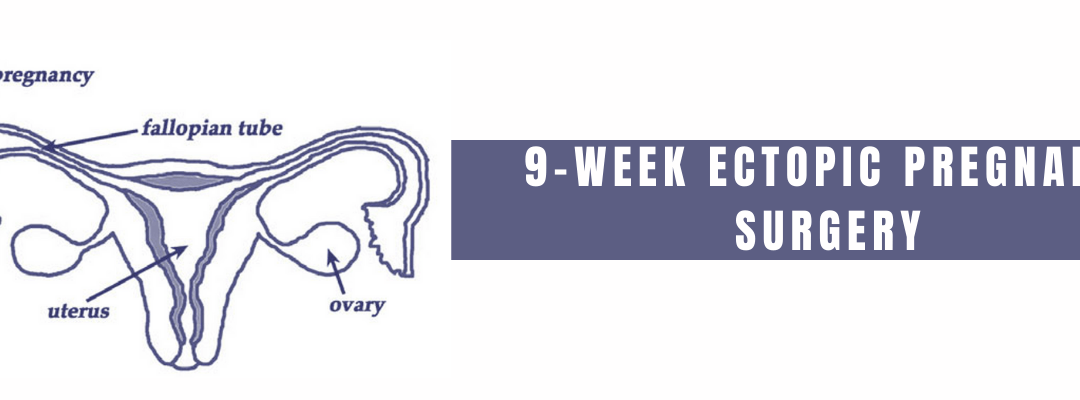 9-Week Ectopic Pregnancy Surgery