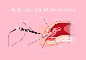 Myomectomy