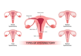 hysterectomy