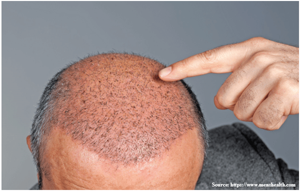 Hair Transplant in Gachibowli