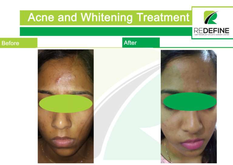 Acne and whitening treatment 768x543 1