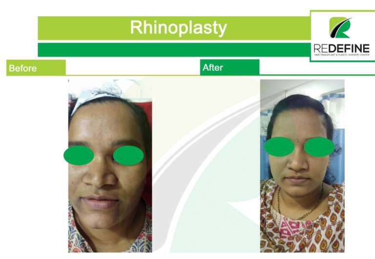 Rhinoplasty before and after