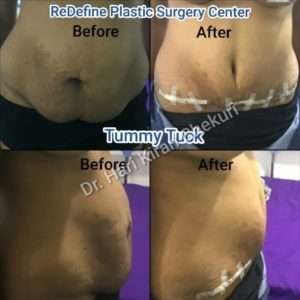 Tummy Tuck 300x300 1