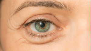 eyelid surgery