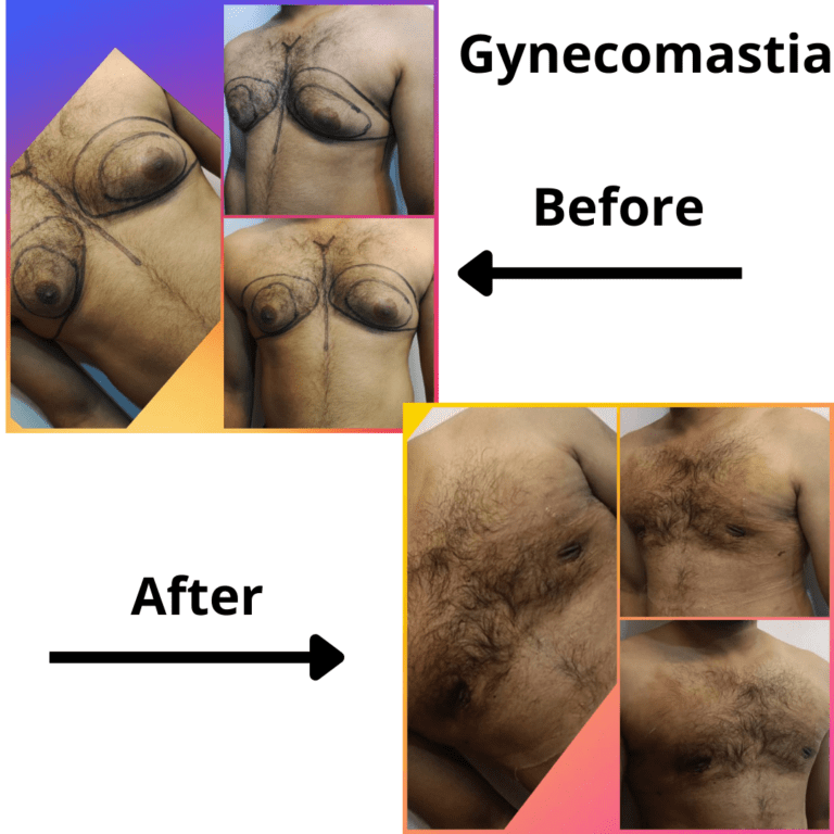 Gynecomastia