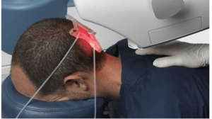 robotic hair transplant 