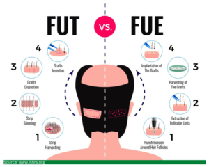 fue hair transplant