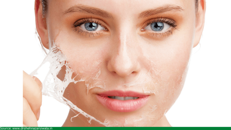 chemical peel in hyderabad