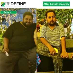 bariatric sugrery