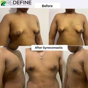 After Gynecomastia Surgery