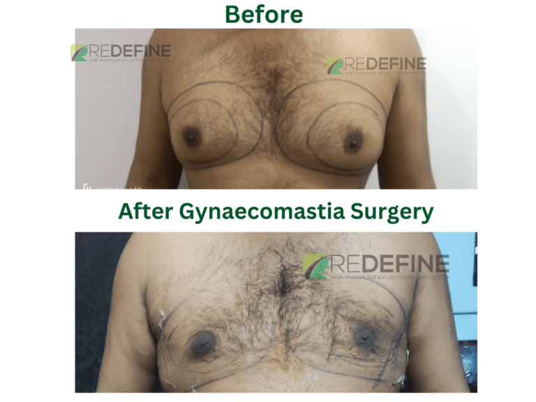 After Gynaecomastia Surgery 2