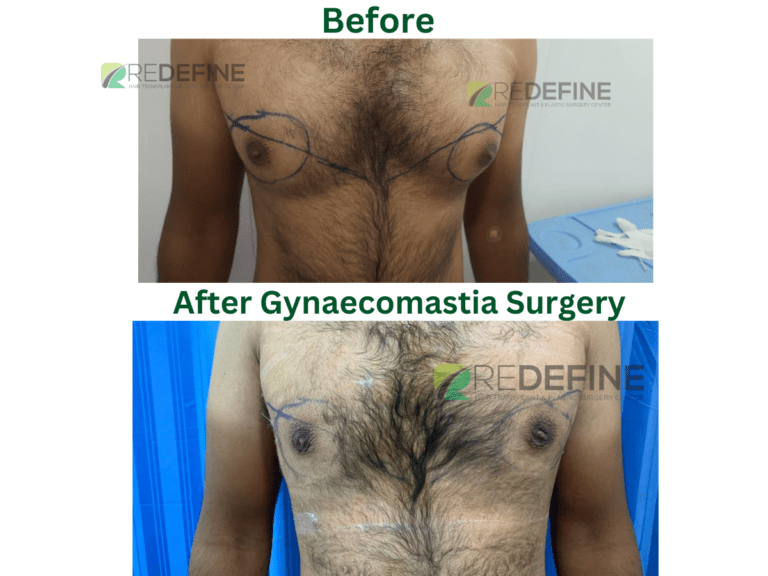 After Gynaecomastia Surgery 3