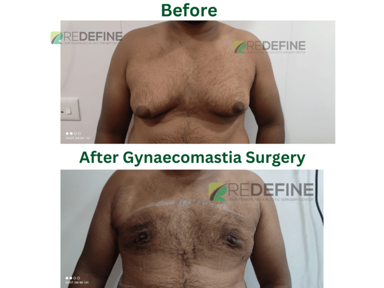 After Gynaecomastia Surgery