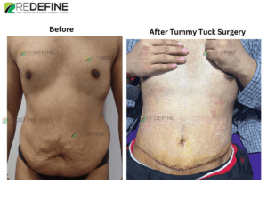 Tummy Tuck before and after