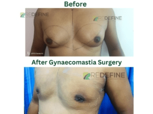 Gynecomastia Surgery in Hyderabad 