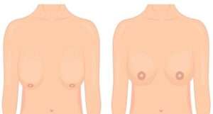 What is Breast lift