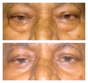 Blepharoplasty