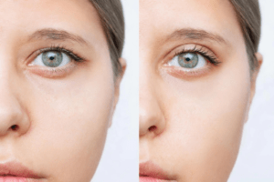 Under eye bag correction 