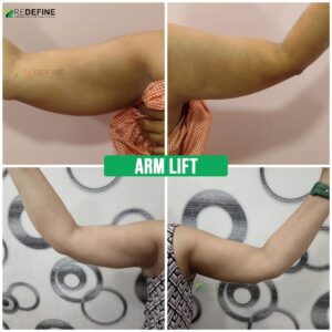 Arm Lift Surgery In Hyderabad
