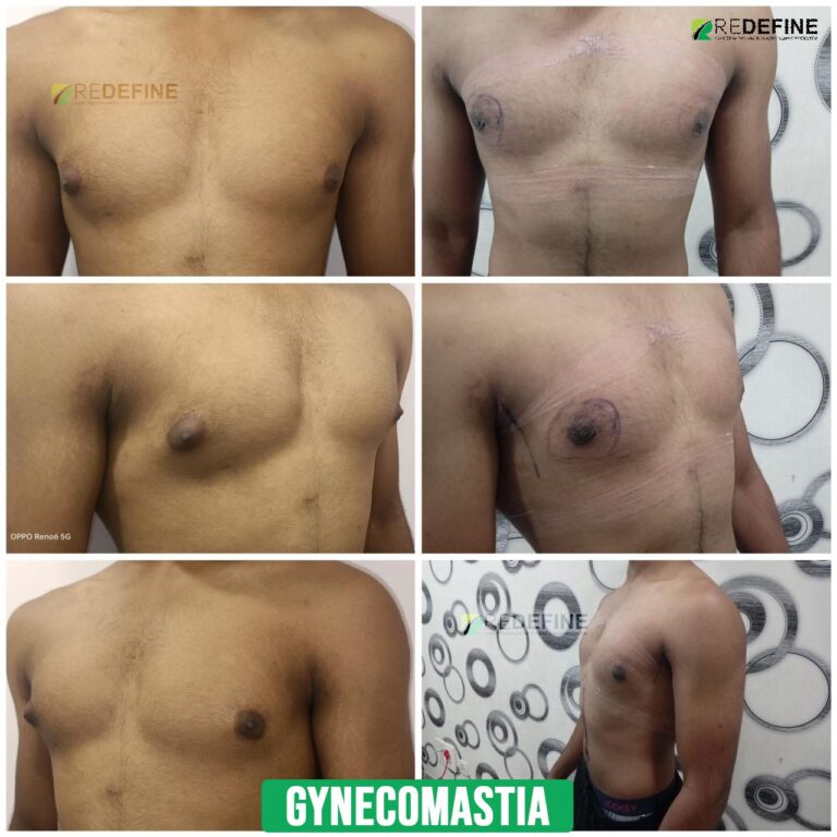 gynecomastia