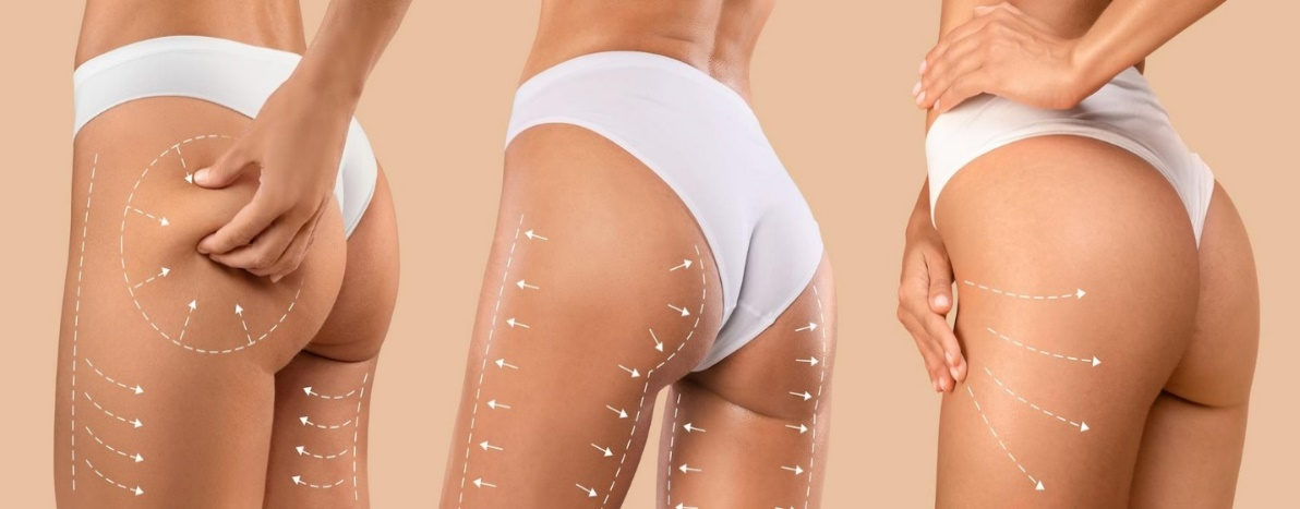 Benefits of Thigh Lift Surgery