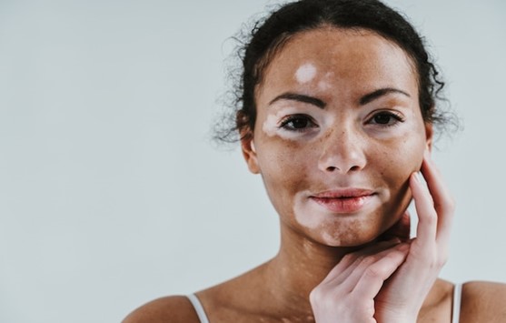 Melanocytes Transfer for Vitiligo 