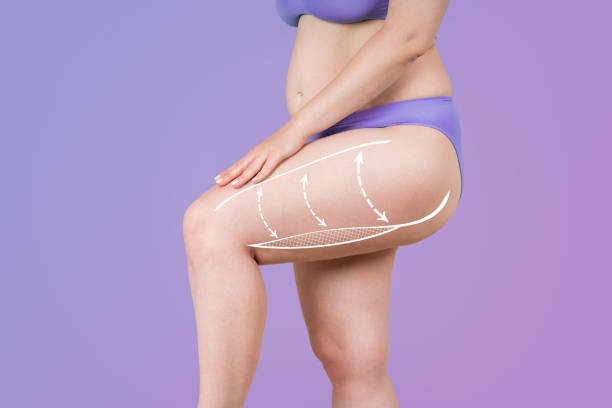 Thigh Lift Surgery Procedure