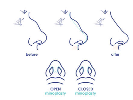 Types rhinoplasty