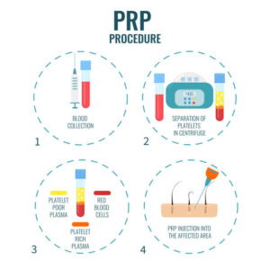 PRP procedure