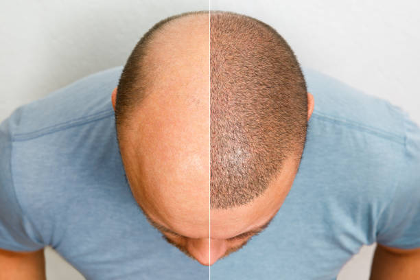 hair transplantation at redefine