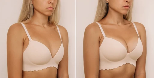 who can opt for breast fillers