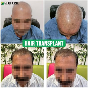 hair transplant