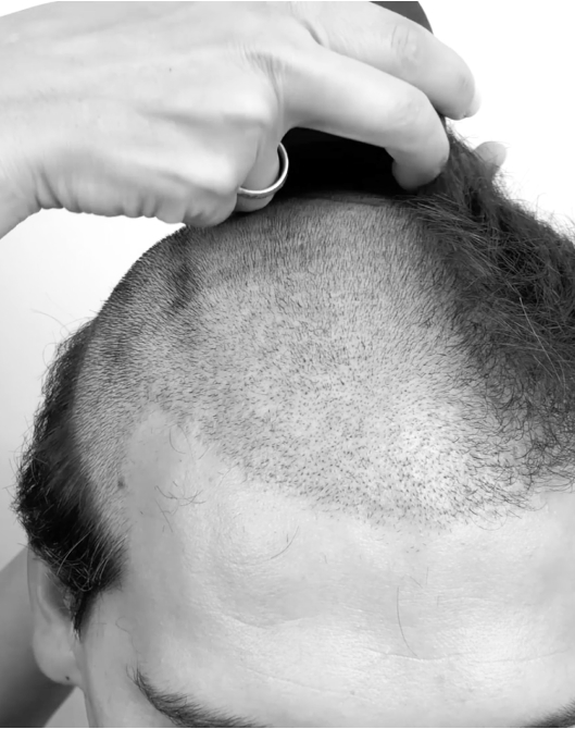 QHT hair transplant technique