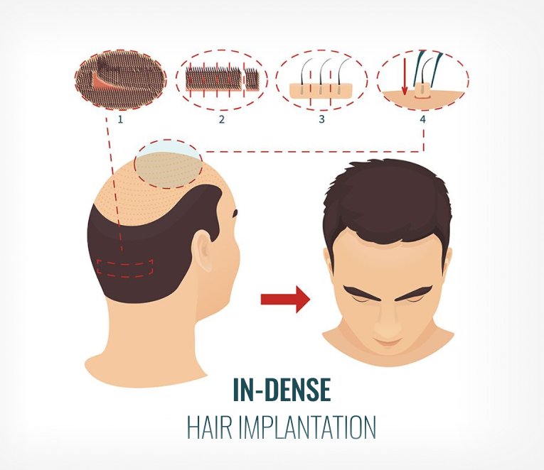 In follicular unit extraction (FUE):