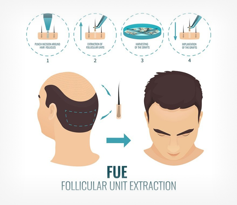 In Follicular Unit Extraction (FUE):