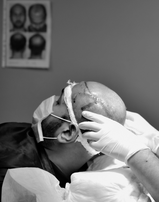 Harvesting of the hair grafts from the donor area