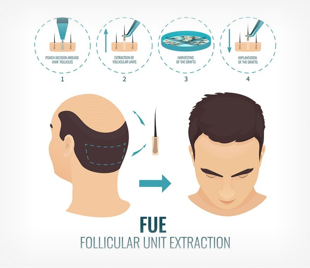 You will find the best FUE hair transplant in India at Regrow clinic. It is the latest and the best method of hair transplant.