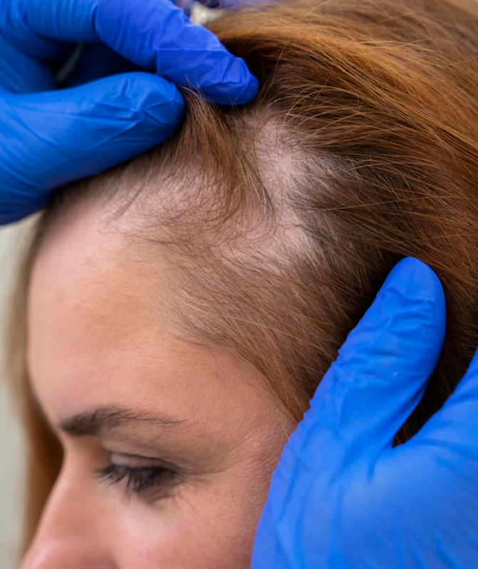 Advantages Of PRP Hair Treatment