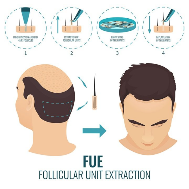 In follicular unit extraction (FUE)