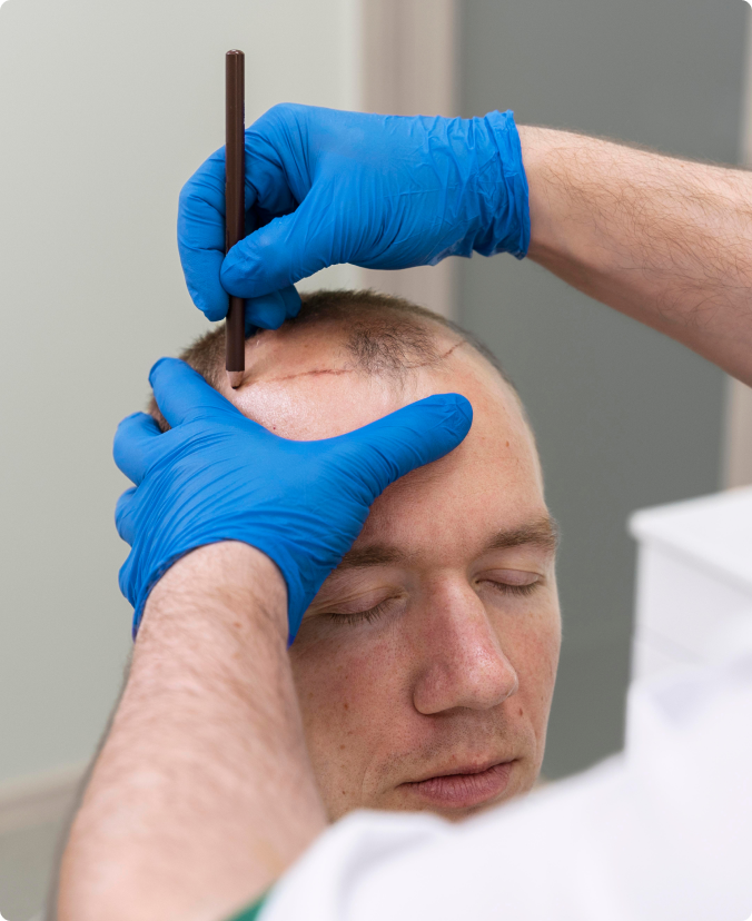 About Hair Transplant